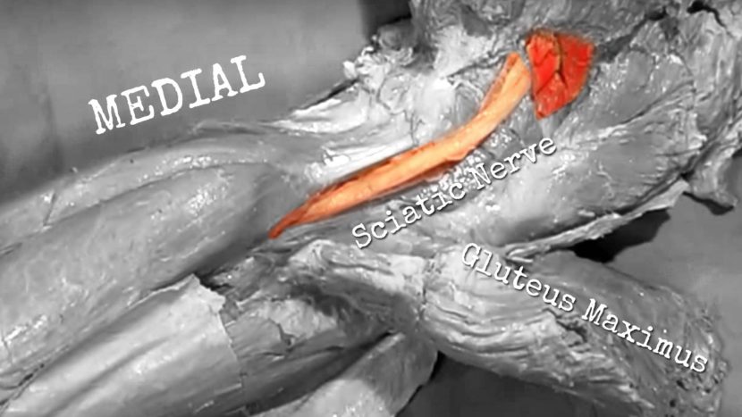 Piriformis Syndrome and the Sciatic Nerve